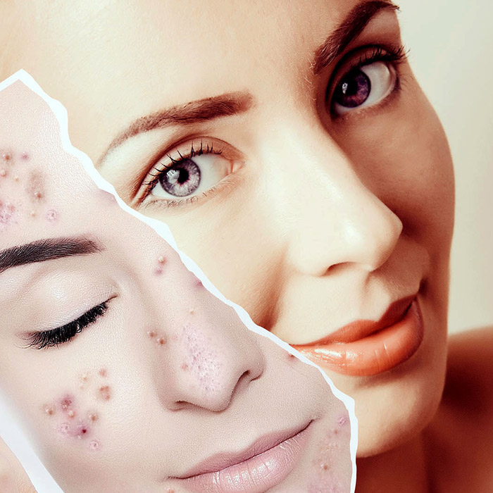 Higiene Facial Profunda Con punta de Diamante